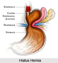 Causes of Hiatus hernia