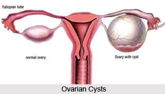 Causes of Ovarian Tumors And Cysts