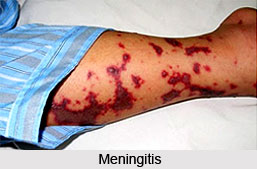 Prevention of Meningitis