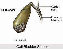 Symptoms of Gall Bladder Stones