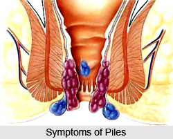 Symptoms of Piles