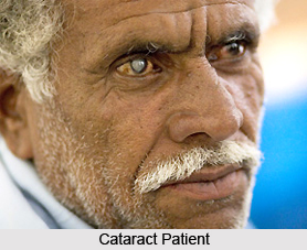 Treatment of Cataract