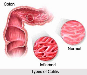 Types of Colitis
