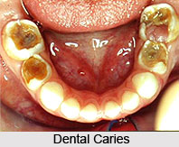 Dental Caries