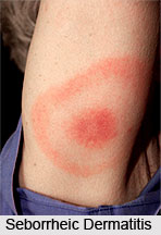 Types of Dermatitis