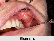 Stomatitis