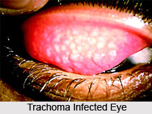 Trachoma or Pothaki