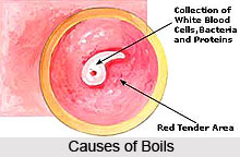 Types of Boils