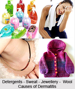 Causes of Dermatitis
