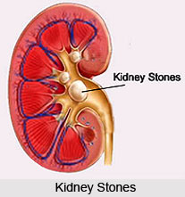 Causes of kidney Stones
