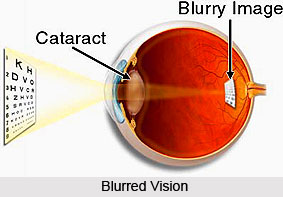 Symptoms of Cataract