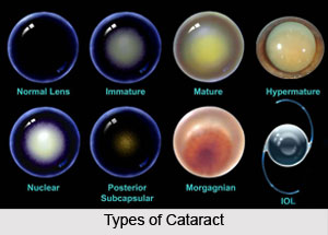 Types of Cataract