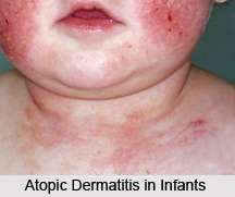 Atopic Dermatitis, Allergic Disease