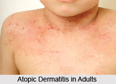 Atopic Dermatitis, Allergic Disease
