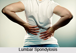 Treatment of Lumbar Spondylosis