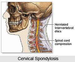 Treatment of Cervical Spondylosis
