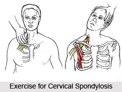 Treatment of Cervical Spondylosis