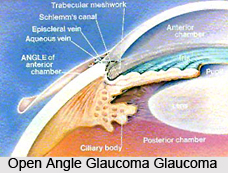 Types of Glaucoma