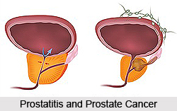 Types of Prostate Disorders