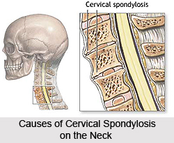 Causes of Cervical Spondylosis