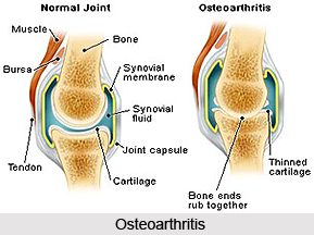 Osteoarthritis, Bone disease