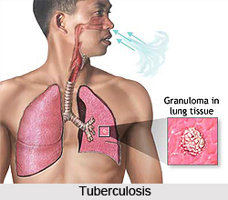 Tuberculosis or Rajayakshma