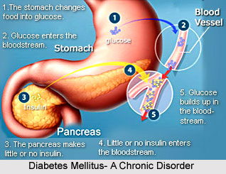 Yoga for Diabetes