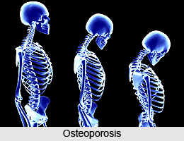 Bone Ailments