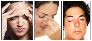 Sinusitis