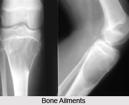 Bone Ailments