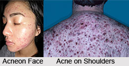 Acne