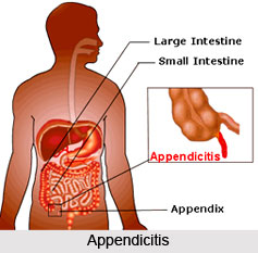 Appendicitis