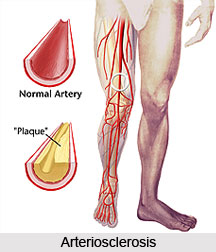 Arteriosclerosis
