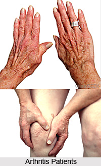 Treatment of Arthritis
