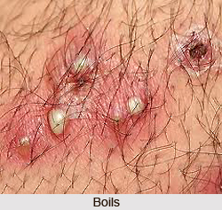 Treatment of Boils