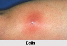 Boils, Skin Disorder