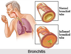 Bronchitis