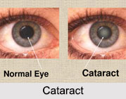 Cataract, Eye Disorder