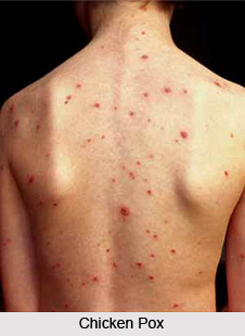 Symptoms of Chicken Pox