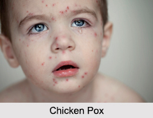 Chicken Pox, Infectious Disease