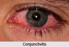 Conjunctivitis