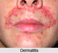 Dermatitis