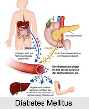 Diabetes Mellitus, Blood Related Ailment