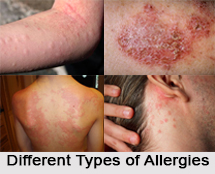 Allergies