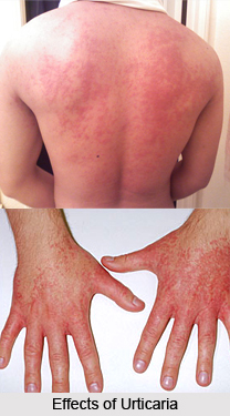 Treatments of Urticaria