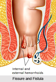 Treatment of Fissure and Fistula