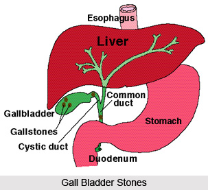 Treatment of Gall Bladder Stones
