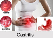 Gastritis, Stomach Ailment