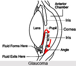 Causes of Glaucoma