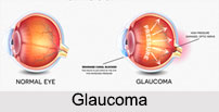 Glaucoma, Eye Disorder
